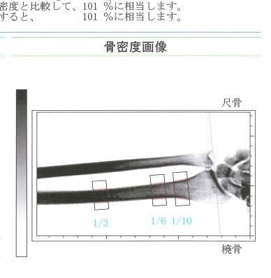 骨密度の検査結果