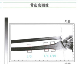 骨密度の検査結果